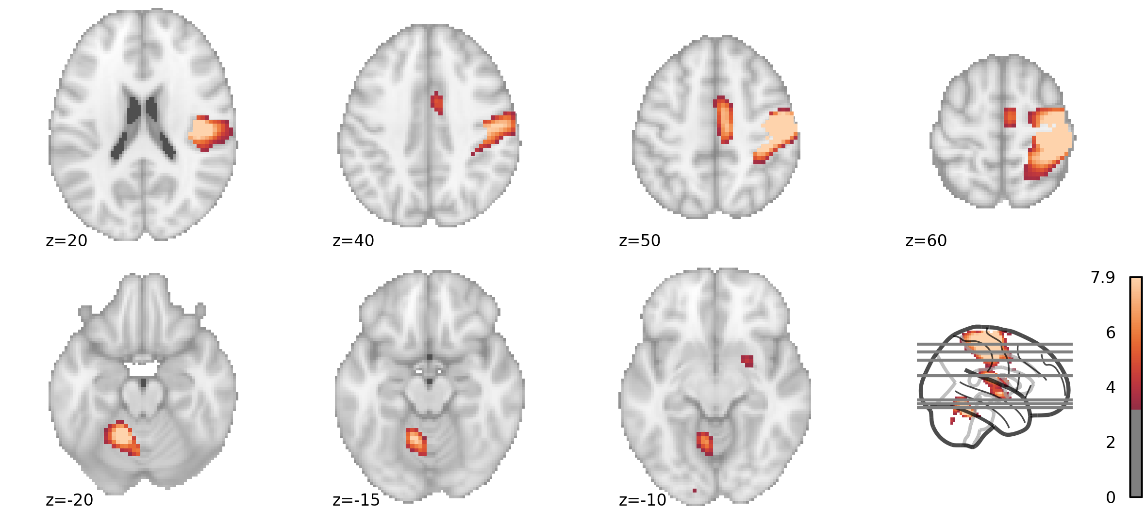 /img/combining-nilearn-plots/combined_figure.png